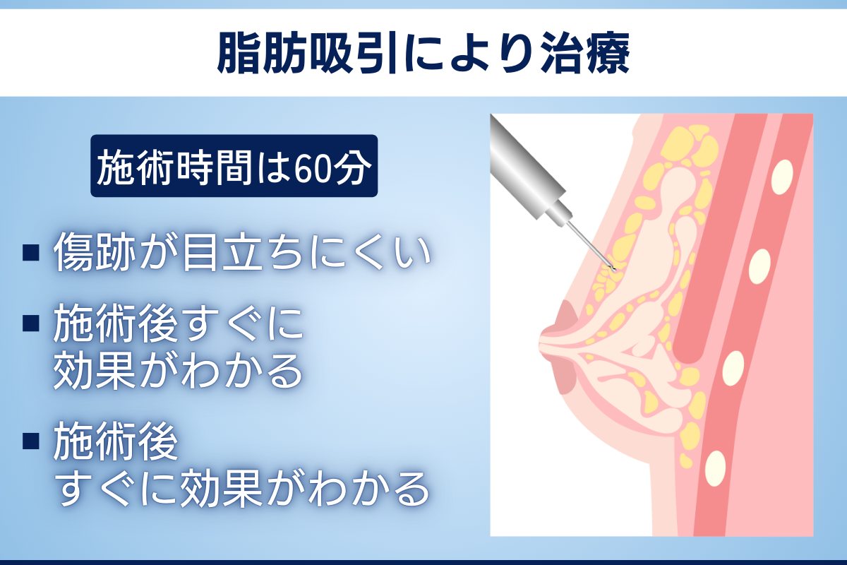 女性化乳房の治療法