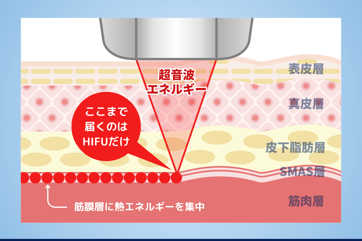 メンズのハイフ施術で得られる効果と期待できるメリット