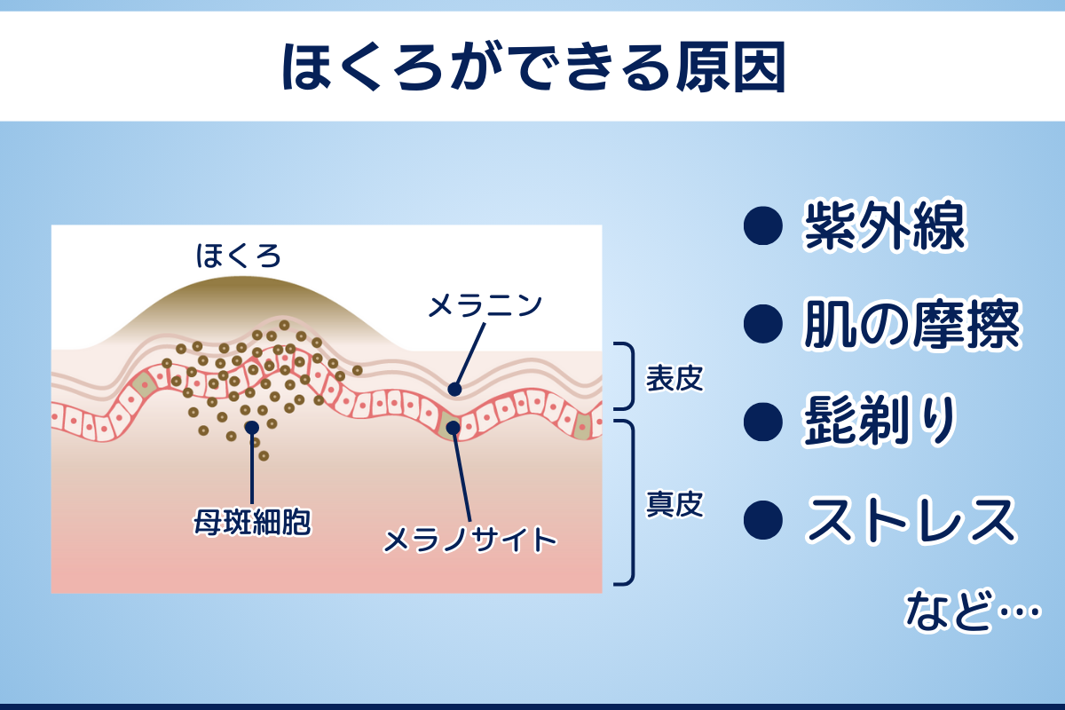 メンズ　ほくろができる原因