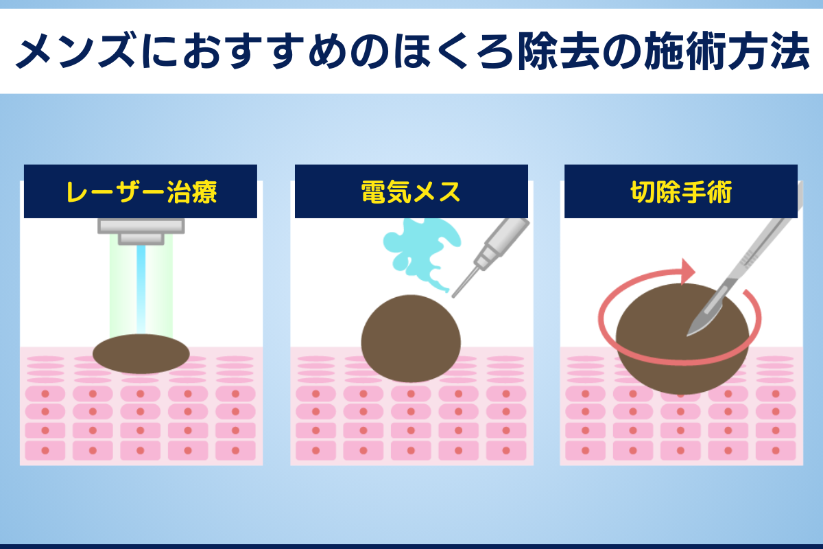 メンズ　ほくろ除去　施術方法