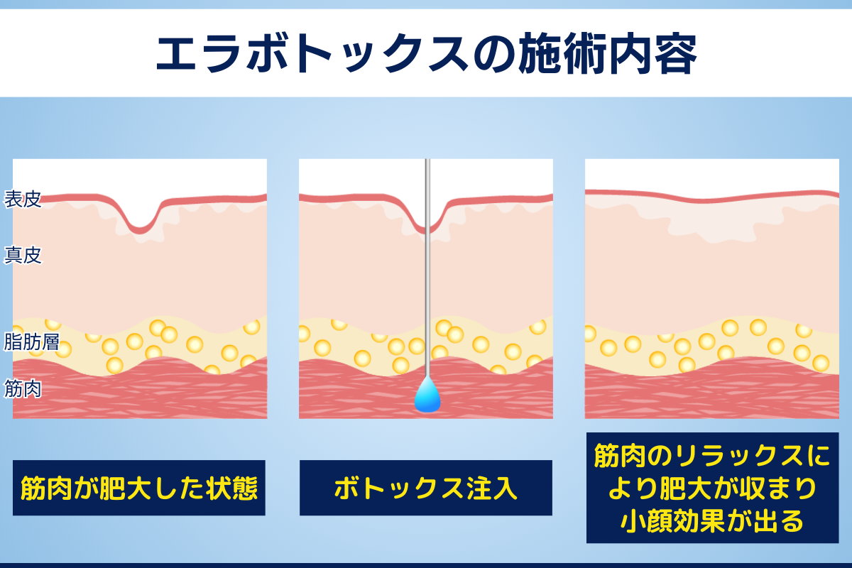 エラボトックスの施術内容